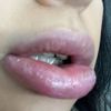 Allergische Reaktion nach Lippen aufspritzen? - 29888
