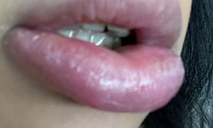 Allergische Reaktion nach Lippen aufspritzen? - 29888