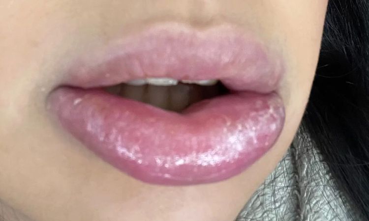 Allergische Reaktion nach Lippen aufspritzen? - 29889