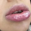 Allergische Reaktion nach Lippen aufspritzen? - 29890