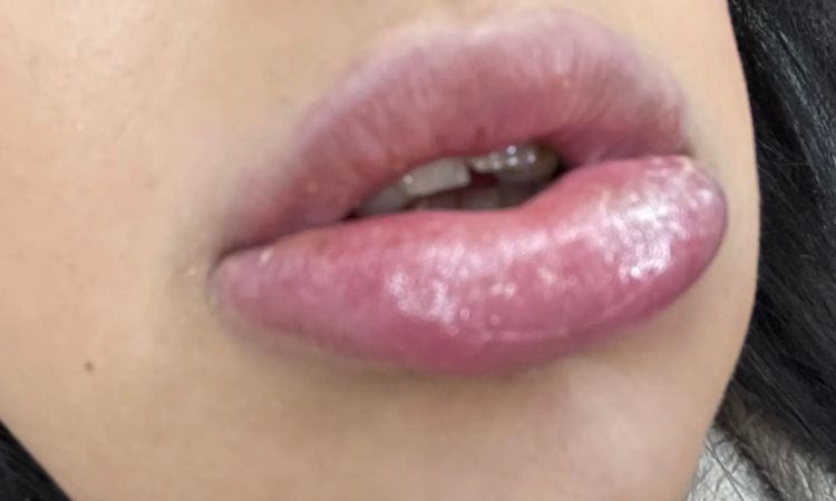 Allergische Reaktion nach Lippen aufspritzen? - 29890