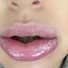 Allergische Reaktion nach Lippen aufspritzen? - 29891