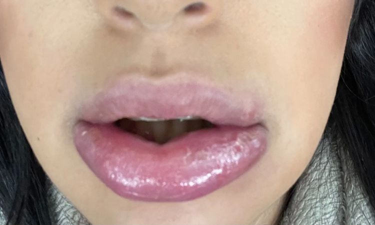 Allergische Reaktion nach Lippen aufspritzen? - 29891