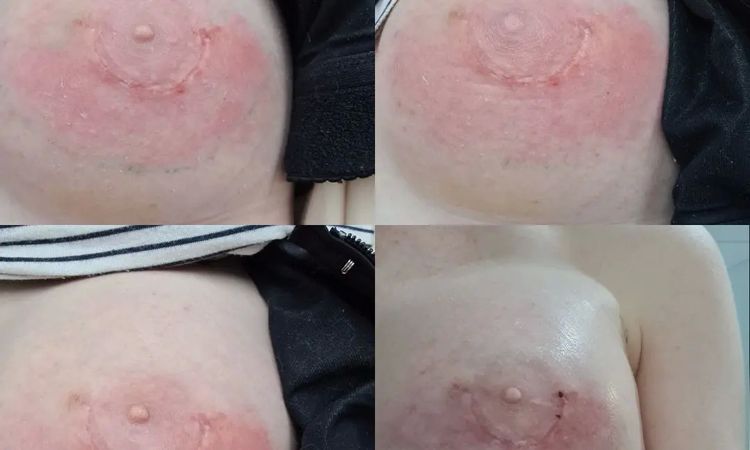 Infektion nach Brustvergrößerung - 29897