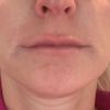 Asymmetrische Lippen nach Hyaluronunterspritzung - 29898