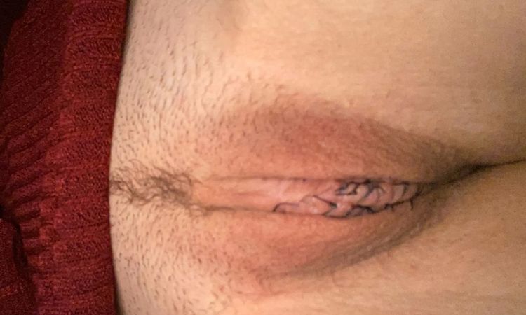 Labienkorrektur ungleichmäßig nach 4 Wochen und Fäden lösen sich nicht - 29954
