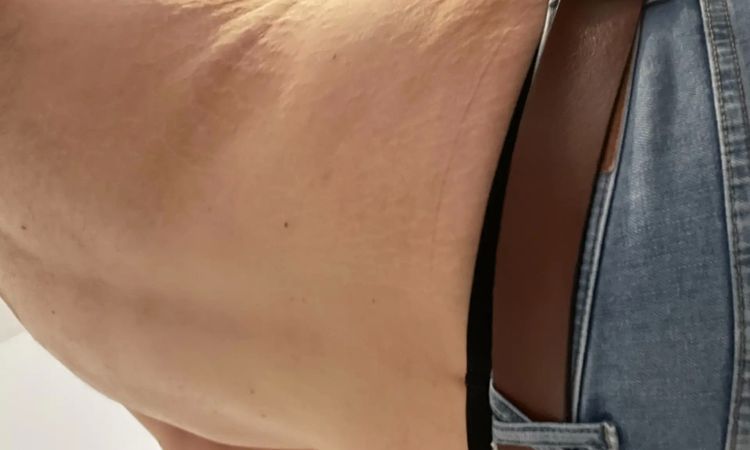 Überschüssige Haut oder Fett?  - 29960