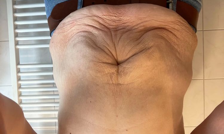 Überschüssige Haut oder Fett?  - 29962