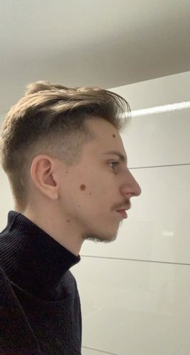 Fliehendes Kinn / Jawline Korrektur - Estheticon.de