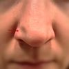 Delle am Nasenflügel nach Nasenkorrektur (5 Wochen post OP) - 30064
