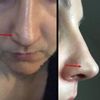 Delle am Nasenflügel nach Nasenkorrektur (5 Wochen post OP) - 30066