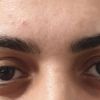 Oberlidstraffung Augebrauenanhebung, Welche Methode  - 30082