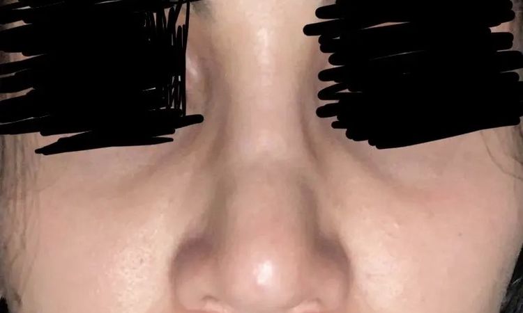 Rhinoplasty - sehr unzufriedenes Ergebnis - 30107