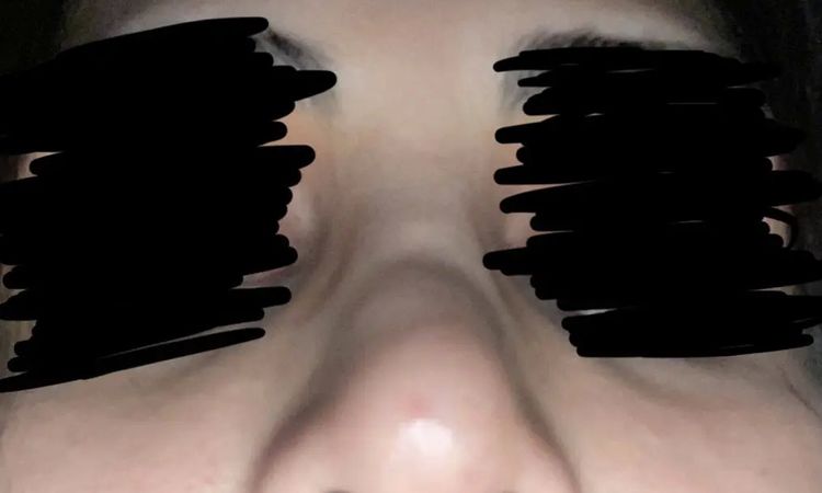 Rhinoplasty - sehr unzufriedenes Ergebnis - 30108