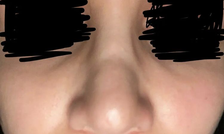 Rhinoplasty - sehr unzufriedenes Ergebnis - 30109