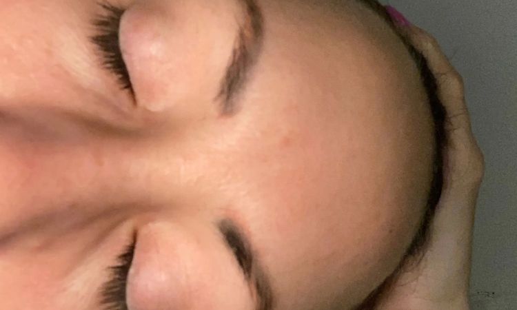 suche einen Arzt zur Augenbrauenhaartranspla... - 30117