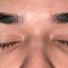 dunkle Augenringe nach Hyaluronbehandlung  - 30121