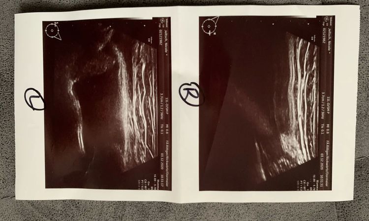 Implantatsruptur ja oder nein? - 30125