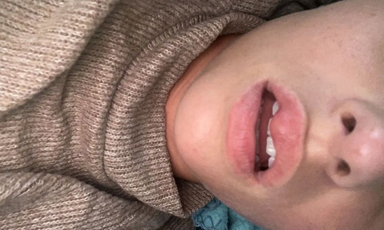 Extreme Lippenschwellung nach 6 Monaten Lipfiller. MS Patientin - 30127