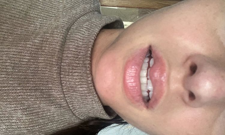 Extreme Lippenschwellung nach 6 Monaten Lipfiller. MS Patientin - 30128