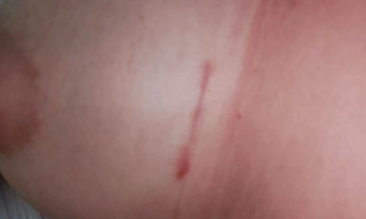 Narben nach Brust OP - 30155