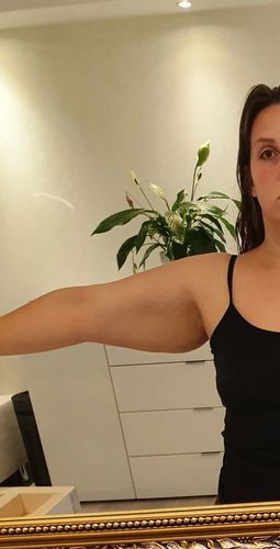 Suche Arzt für Oberarmstraffung in Kombination mit Fettabsaugung!