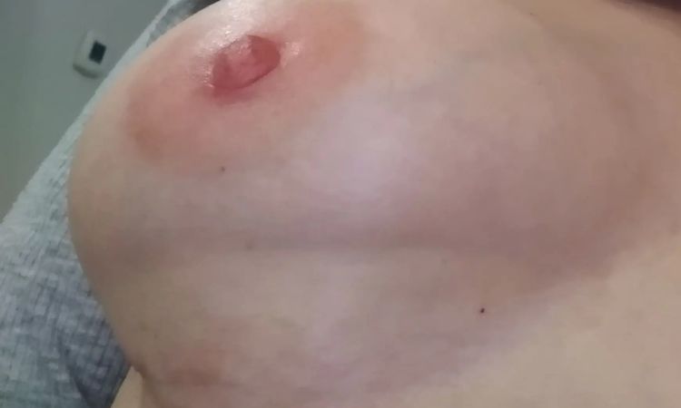 Brustverformung 4 Monate post OP, bitte Experten Rat  - 30191