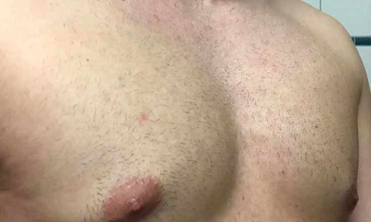 Pseudogynäkomastie Behandlung durch Liposuktion - 30201