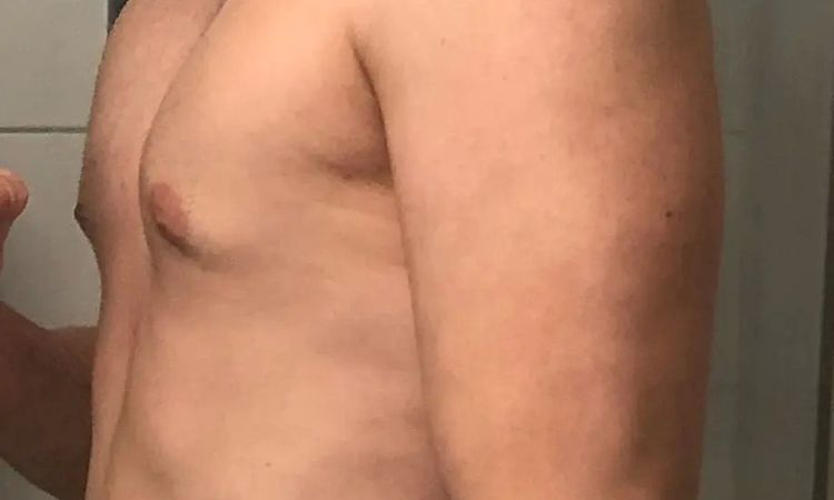 Pseudogynäkomastie Behandlung durch Liposuktion - 30202