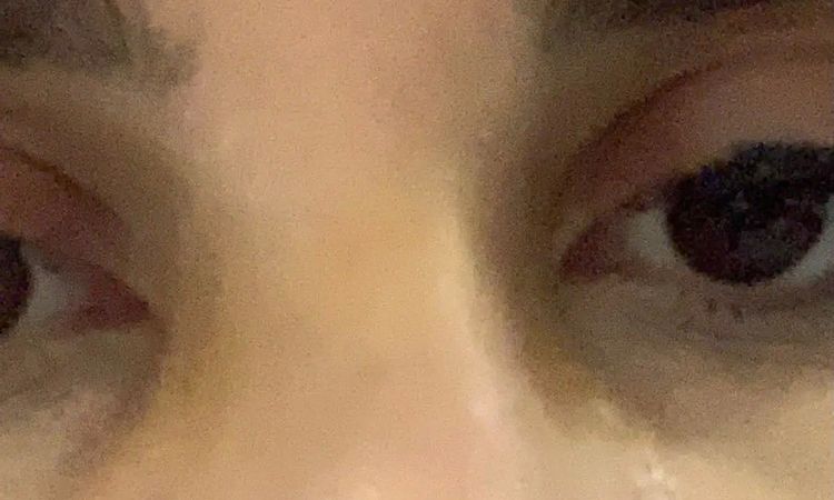 Schiefe Nase nach Nasen Operation - 30207