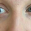 Augenringe mit PRF entfernen? / Alternativen - 30220