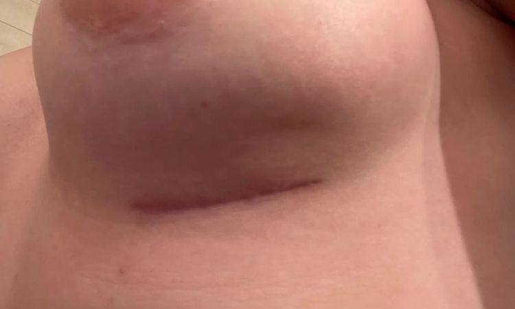 Delle im unteren Bereich der Brust - double bubble oder Kapselfibrose? - 30272