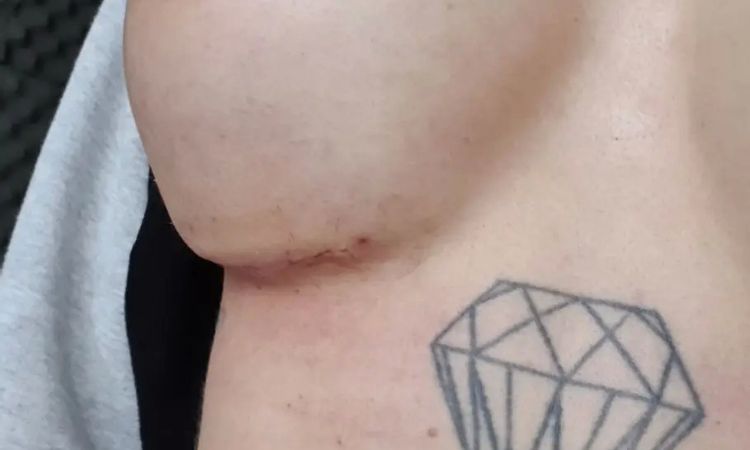 2 Wochen nach BV Delle in der Brust + Spitze Form trotzdem runder Implantate - 30281