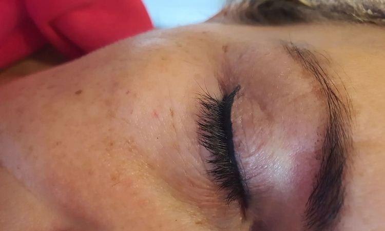 Oberlidstraffung - Knitterfalten auf Augenlid / störend - 30311