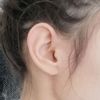 Ohrenkorrektur einseitig