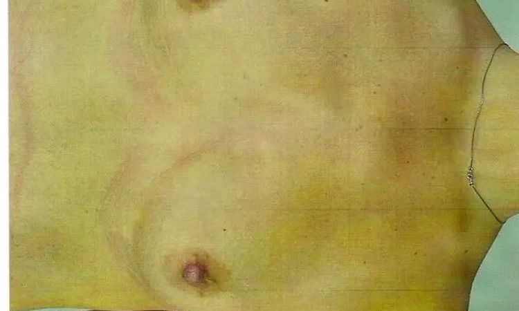Trichterbrust mit Brustvergrößerung  - 30326