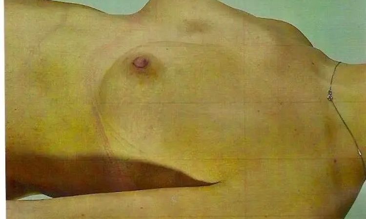 Trichterbrust mit Brustvergrößerung  - 30327
