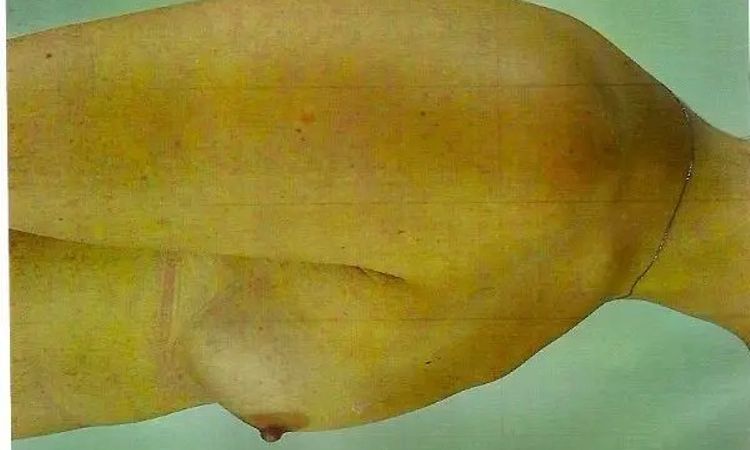 Trichterbrust mit Brustvergrößerung  - 30328