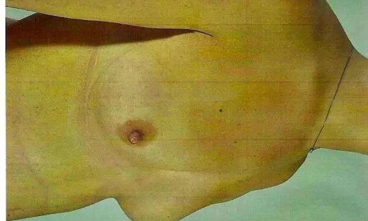 Trichterbrust mit Brustvergrößerung  - 30329