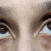 Welche Methode für genetische dunkle Augenringe?