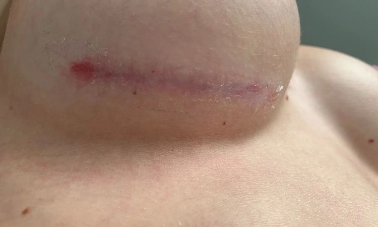 Richtige Narbenpflege nach Brust-OP - 30354