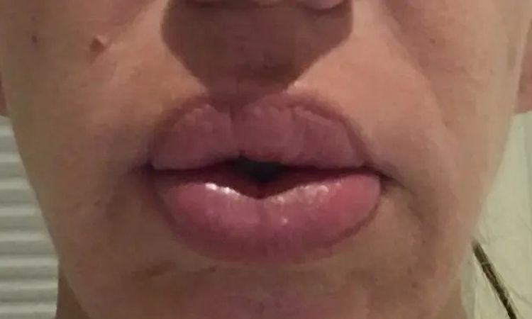  Silikongel aus den Lippen entfernen in Hamburg - 30361