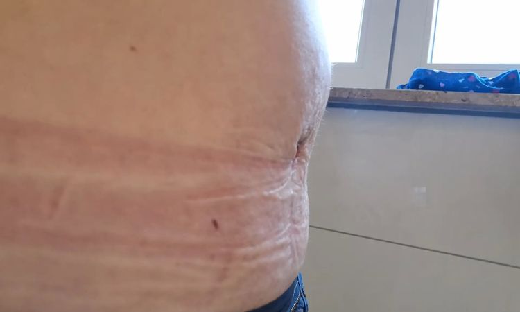 Beule nach Bauchdeckenstraffung und Reparatur Rektusdiastase - 30369