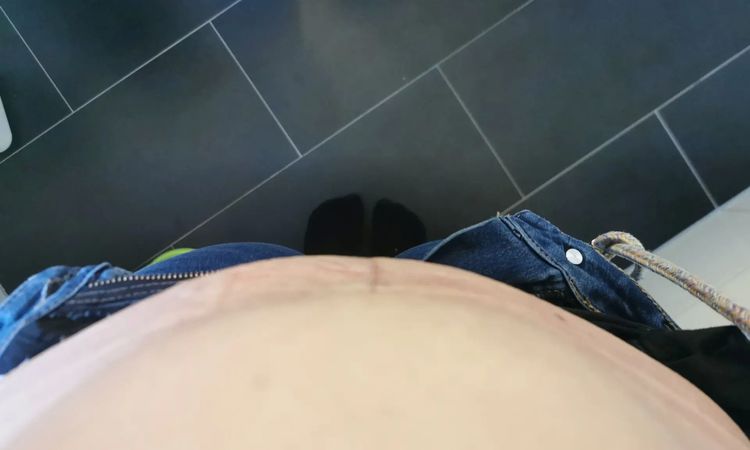 Beule nach Bauchdeckenstraffung und Reparatur Rektusdiastase - 30370