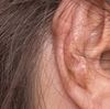 Ohrenkorrektur - Blumenkohl Ohren nach Eingriff, was tun?