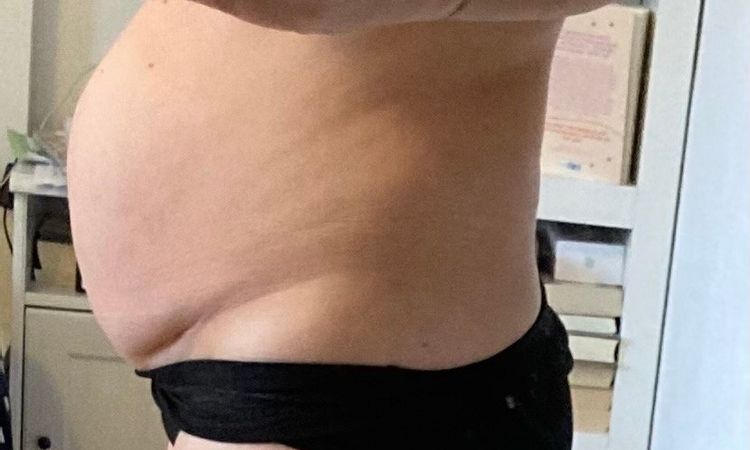 Rektusdiastase, Hernie und Lipo - 32515