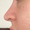 Nasenverschmälerung und Nasenspitzenkorrektur ohne OP