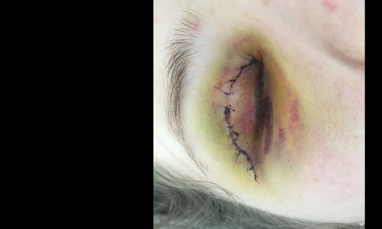 Oberlidstraffung - Versieglung statt Pflaster, können sich so Narben bilden? - 32533