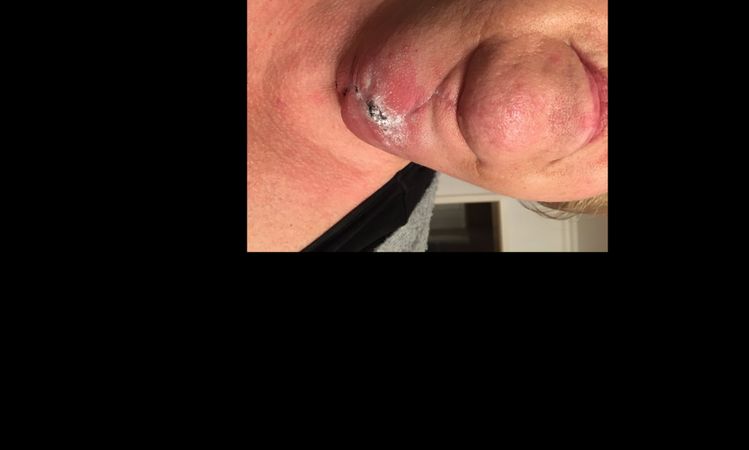 Halsstraffung / Harte & dicke Schwellung an Kinn und Hals, was fördert Heilung? - 32744
