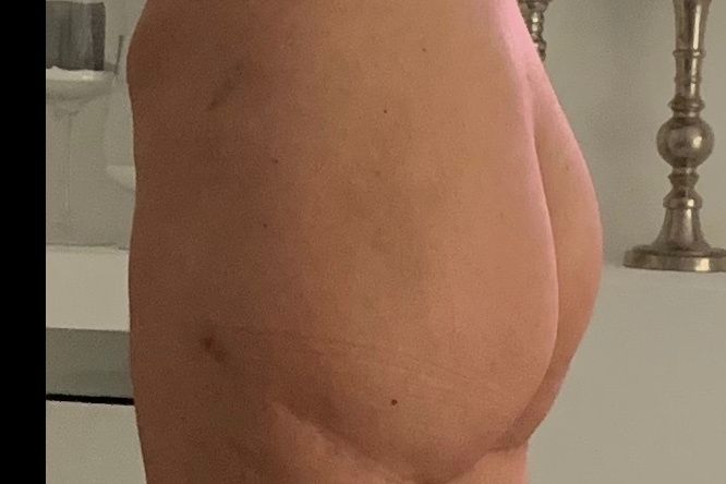 Poimplantat abgerutscht? Wie korrigieren? - 32912
